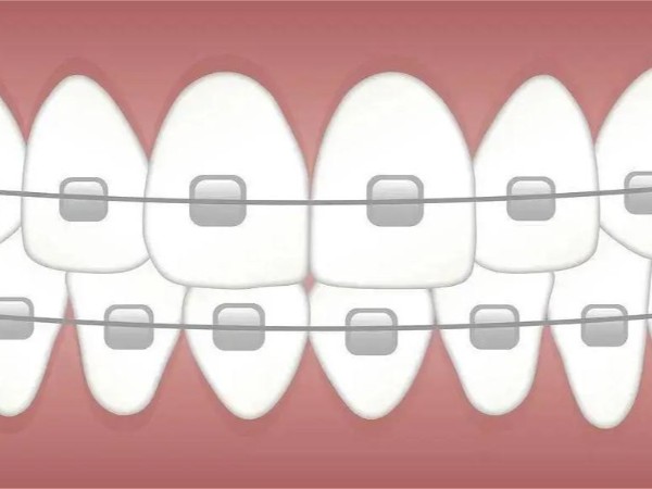 醫用牙托自動整列|排列案例